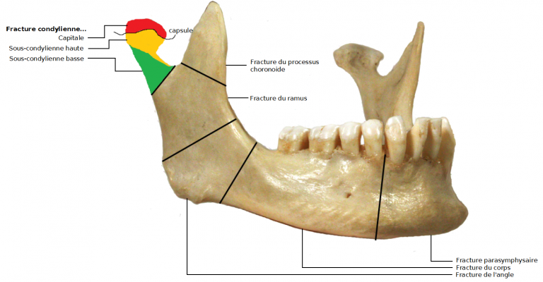 Fracture De La Mandibule Medg 